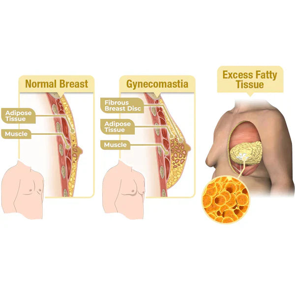 GFOUK™ MenTherm Bee Venom Gynecomastia Heating Oil